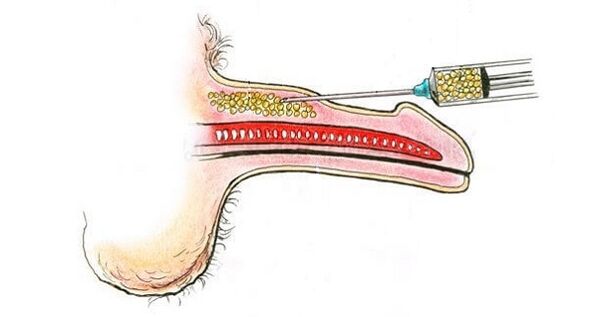 Hyaluronic acid injections in a member barrel in order to increase